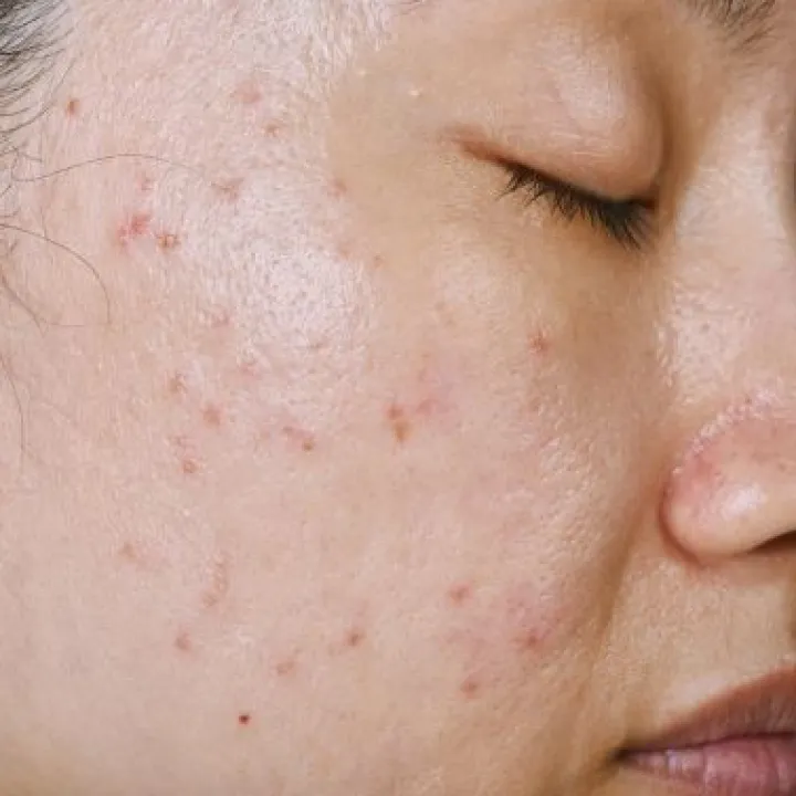 Oily skin